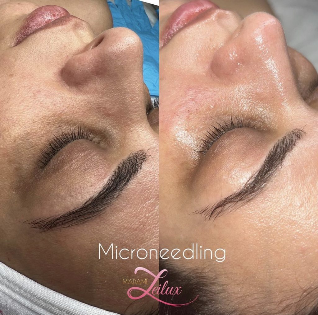 Microneedling