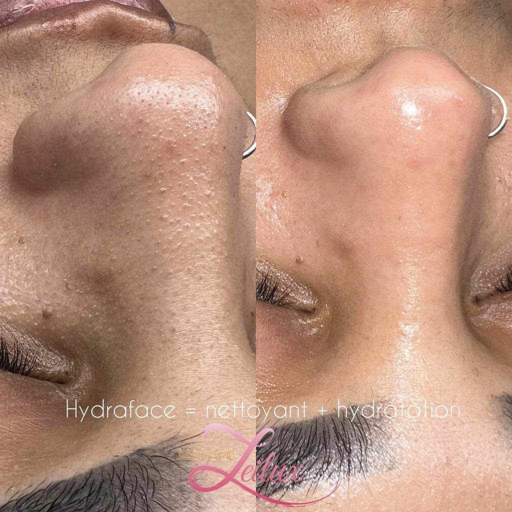Hydraface